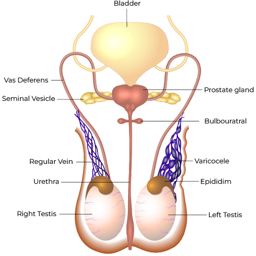 Varicocele