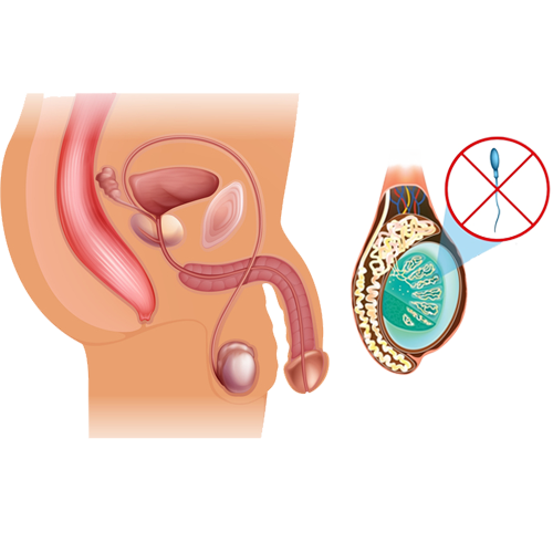 Vas deferens obstruction