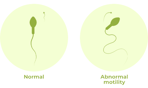 Asthenospermia