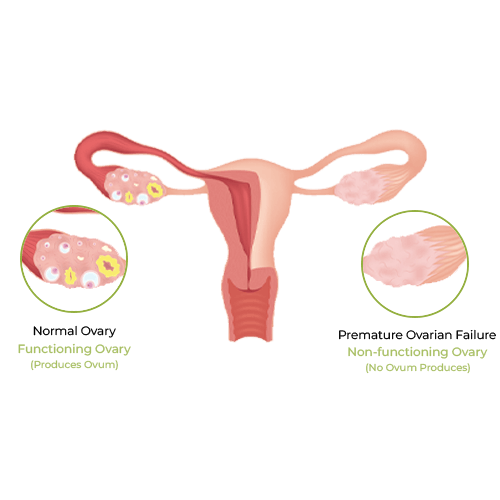 Ovarian Insufficiency