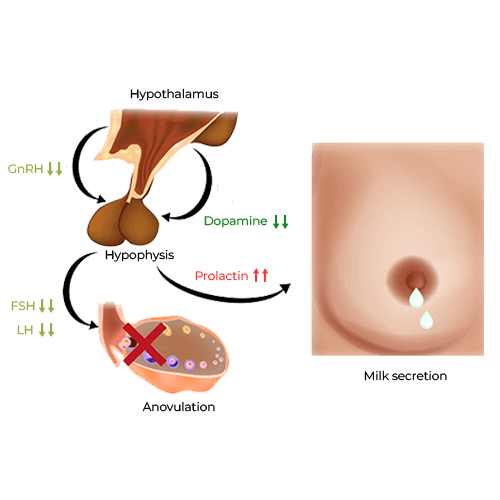 Hyperprolactinemia