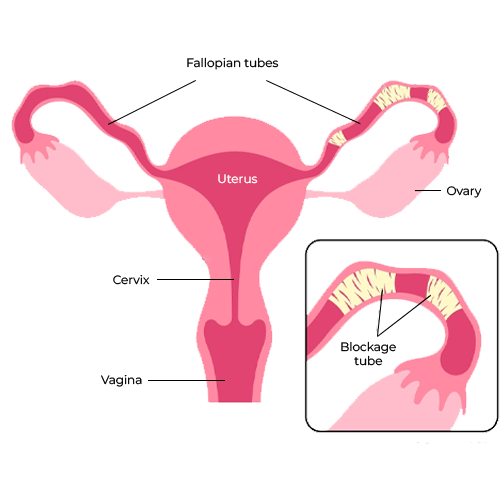 Blocked fallopian tubes