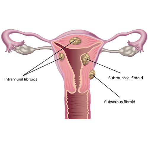 Uterine fibroids