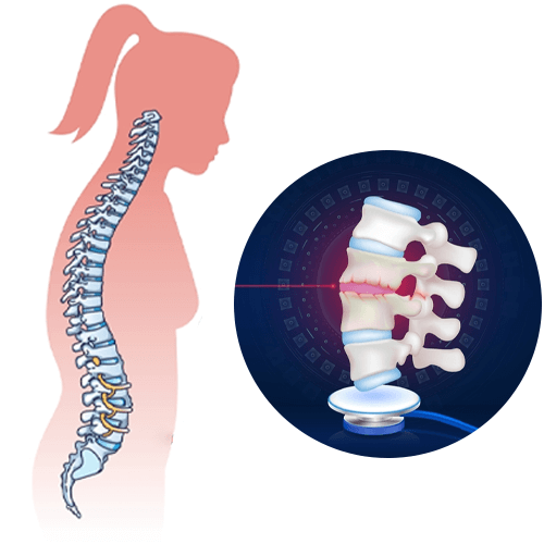 Ankylosing Spondylitis