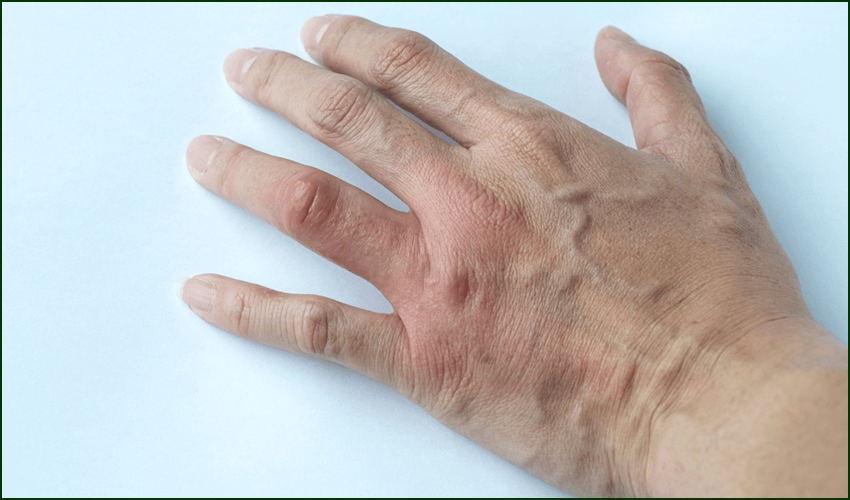 Ayurved Concept for Rheumatoid arthritis