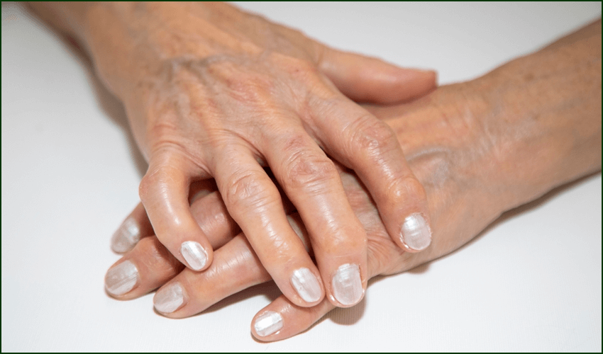 Ayurvedic Arthritis Treatment in Surat