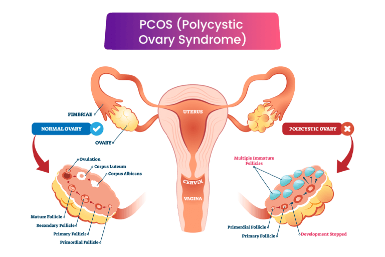 Polycystic Ovary Syndrome PCOS Treatment 